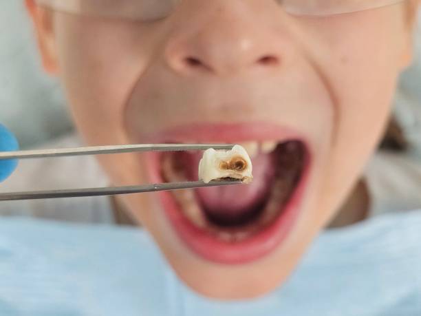 Emergency Dental Filling Replacement in WV